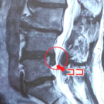 「腰椎椎間板ヘルニア」と診断されました